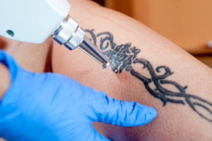 How to get certified in tattoo removal